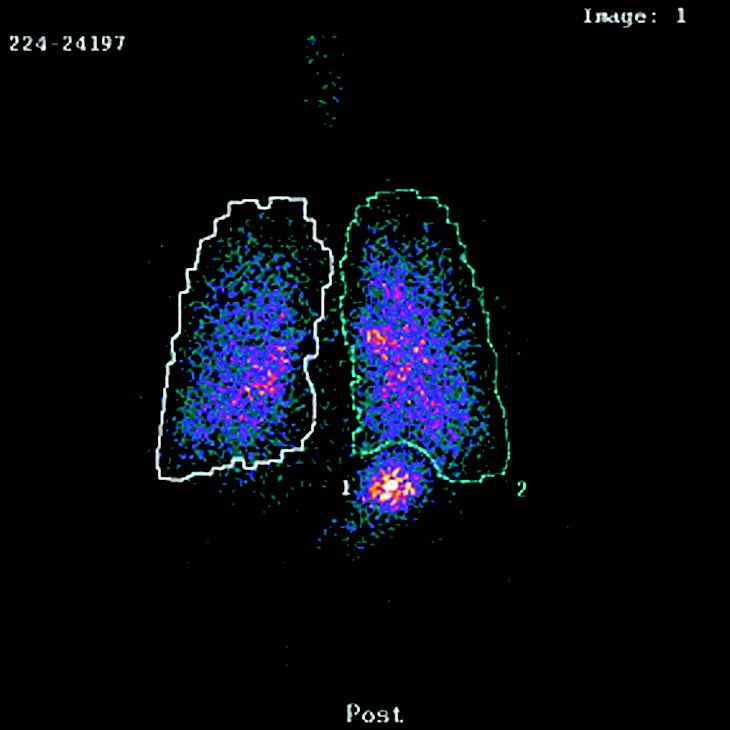 Lung deposition scan before technique training