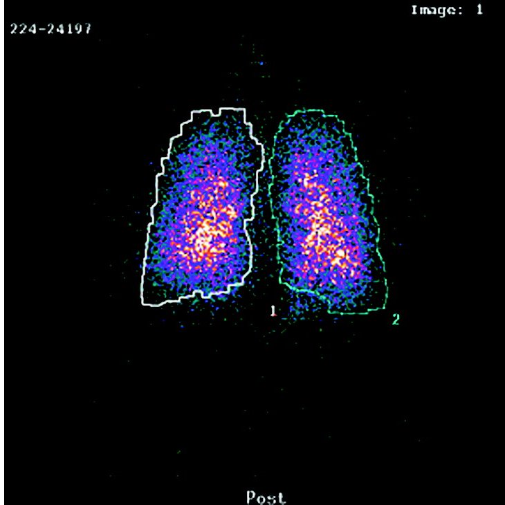 Lung deposition scan after technique training